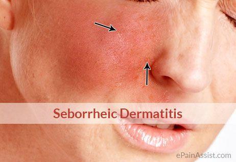 Star reccomend Treating facial atopic dermatitis