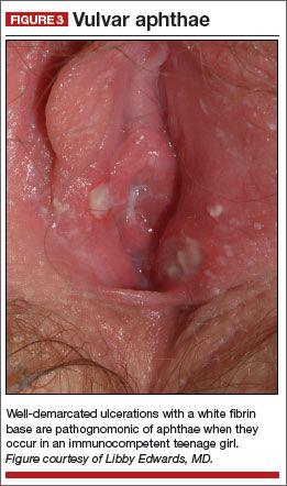 Jewel reccomend Can genital herpes cause swollen vagina