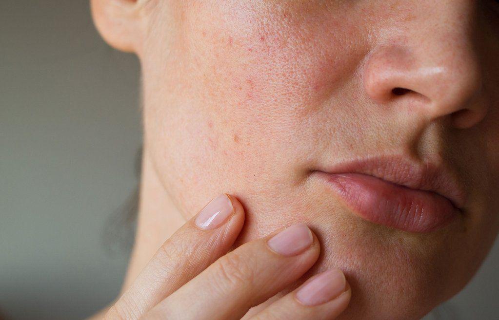 Rolly P. reccomend Facial dermatitis causes