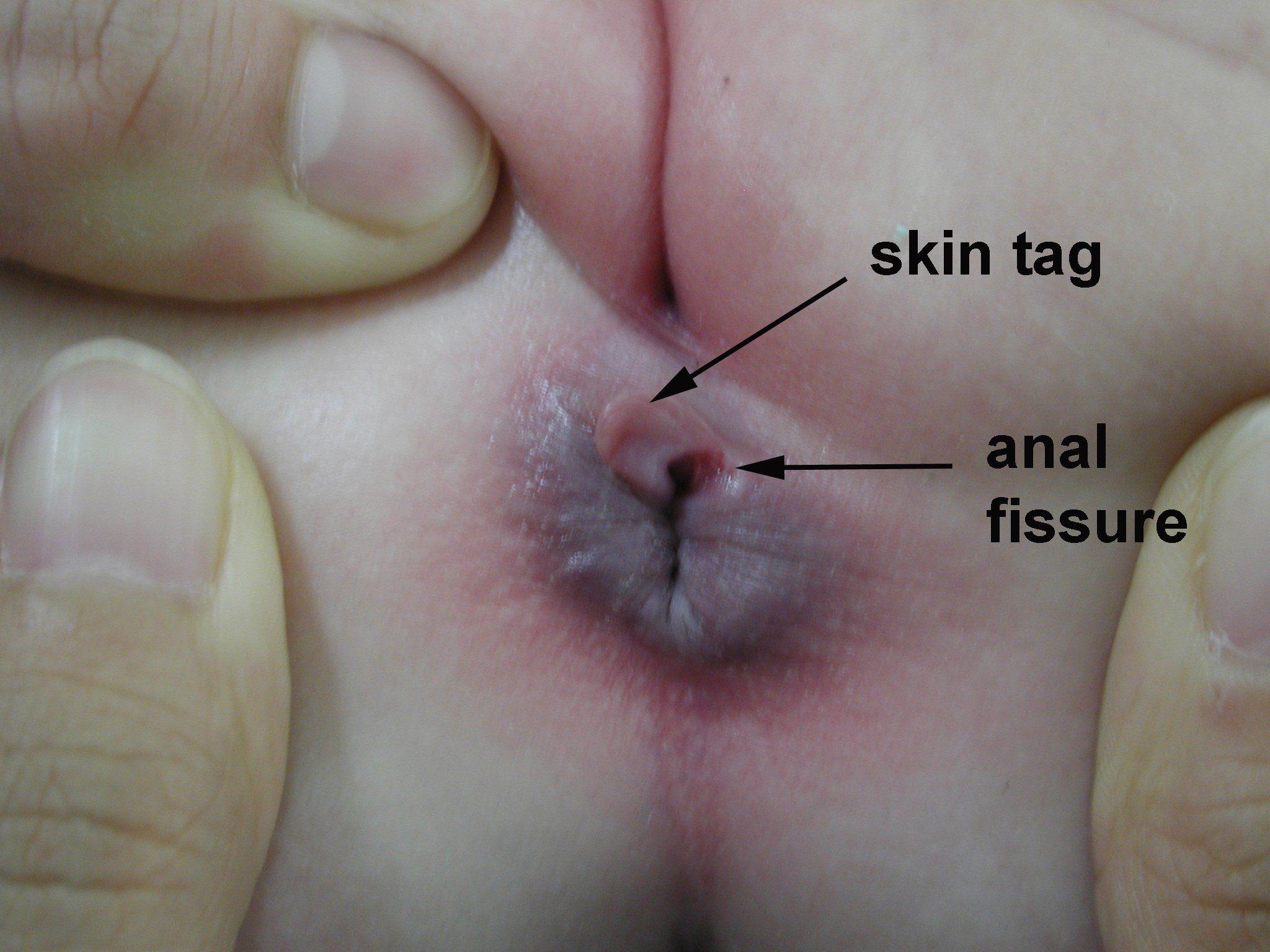 Vulva skin tag pictures