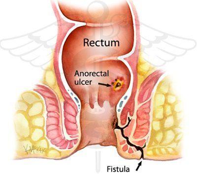 Adult male bowel fistula Fisting