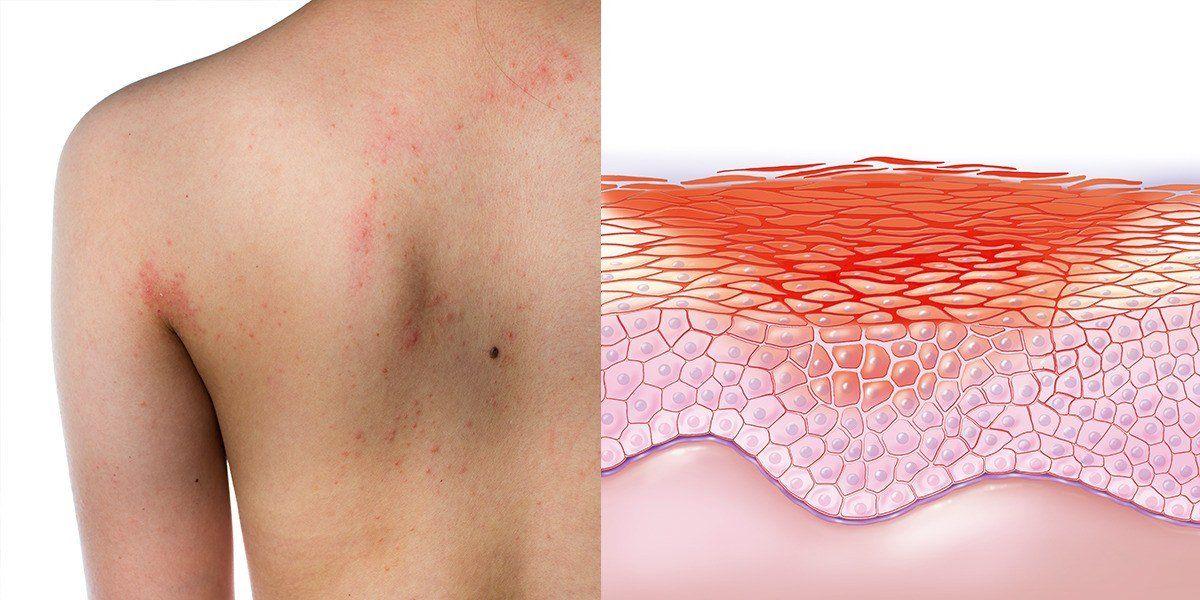 Drum reccomend Clusters of itchy bumps on vagina