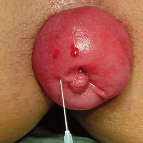 Itching in anus after hysterecotomy