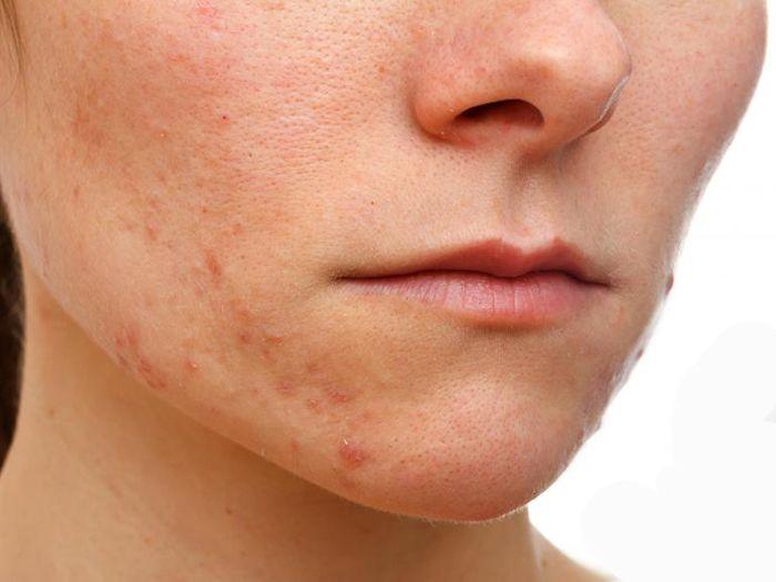 best of Causes Facial dermatitis