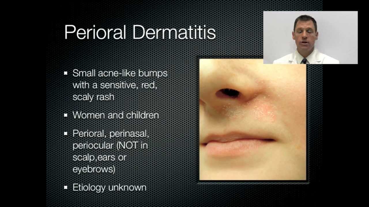 Facial dermatitis causes