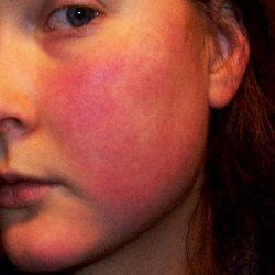 Treating facial atopic dermatitis