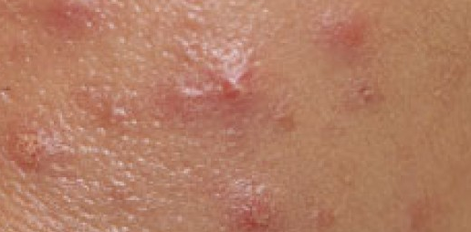 Clusters of itchy bumps on vagina
