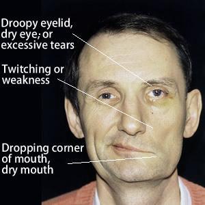 Number S. reccomend Edema facial paralysis hyperacusis excessive tearing