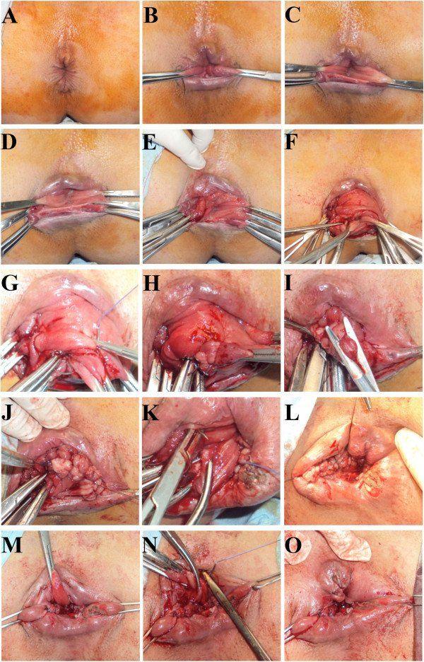 best of Anus hysterecotomy after in Itching