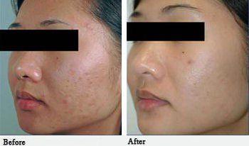 Armed F. recommendet scarrings Treatment for facial