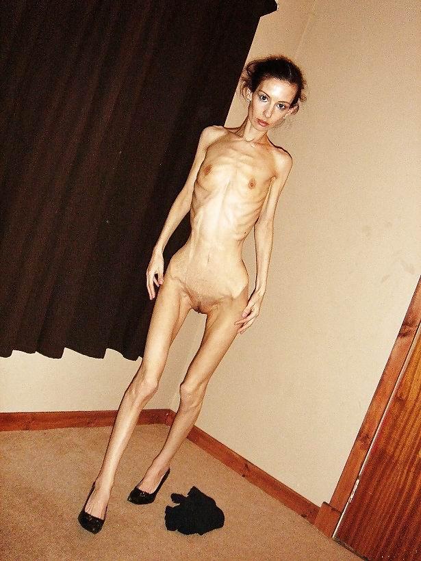 Anorexia nude