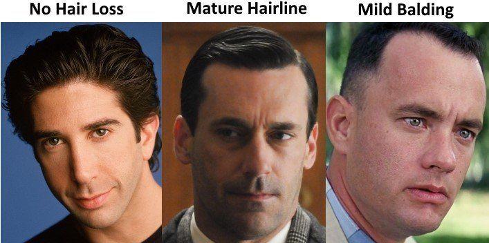 Mature hair line