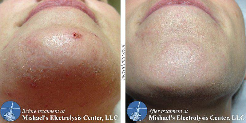 best of Facial removal hair laser Georgia